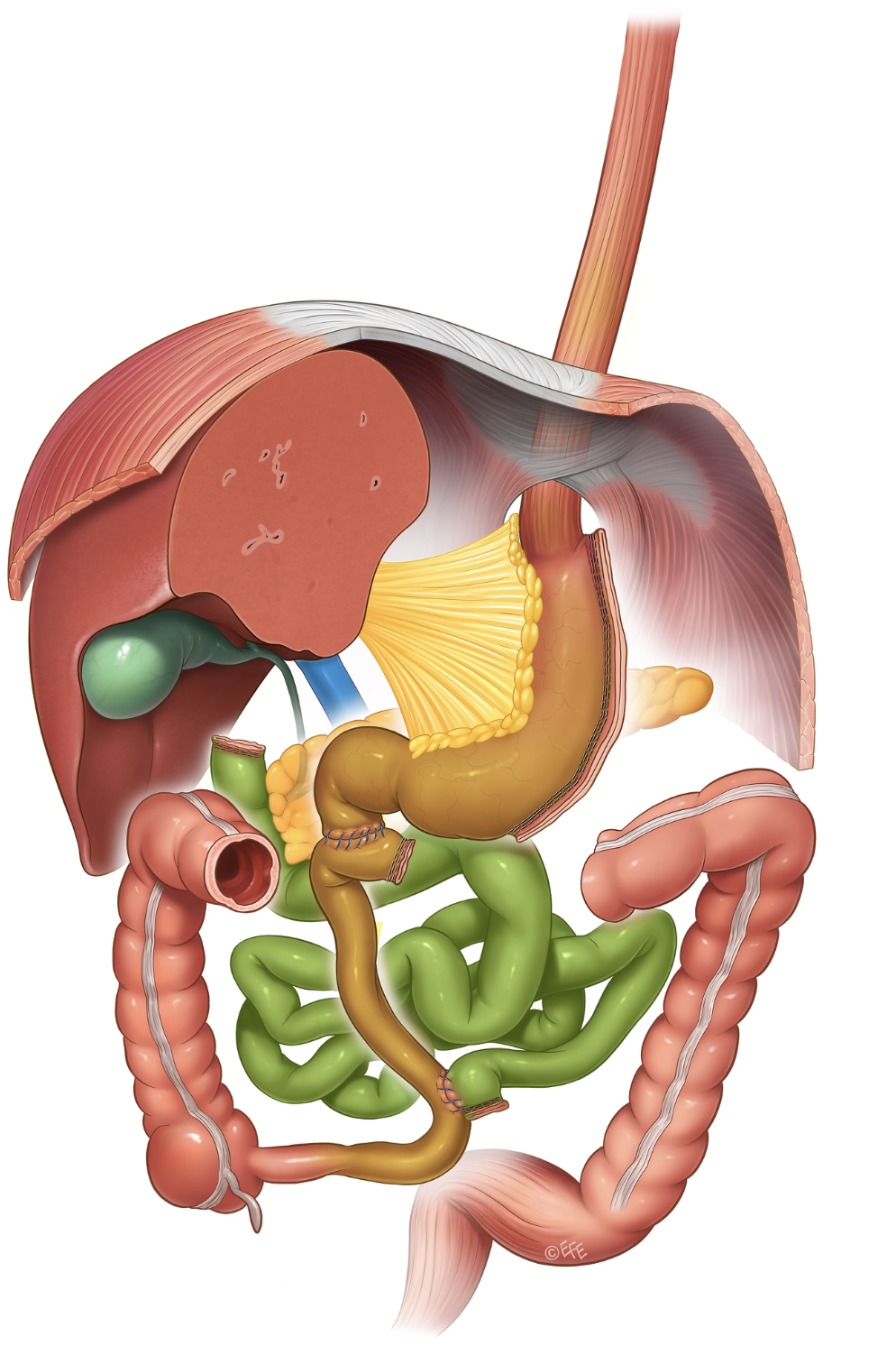 Medizinische Illustration: BPD/DS