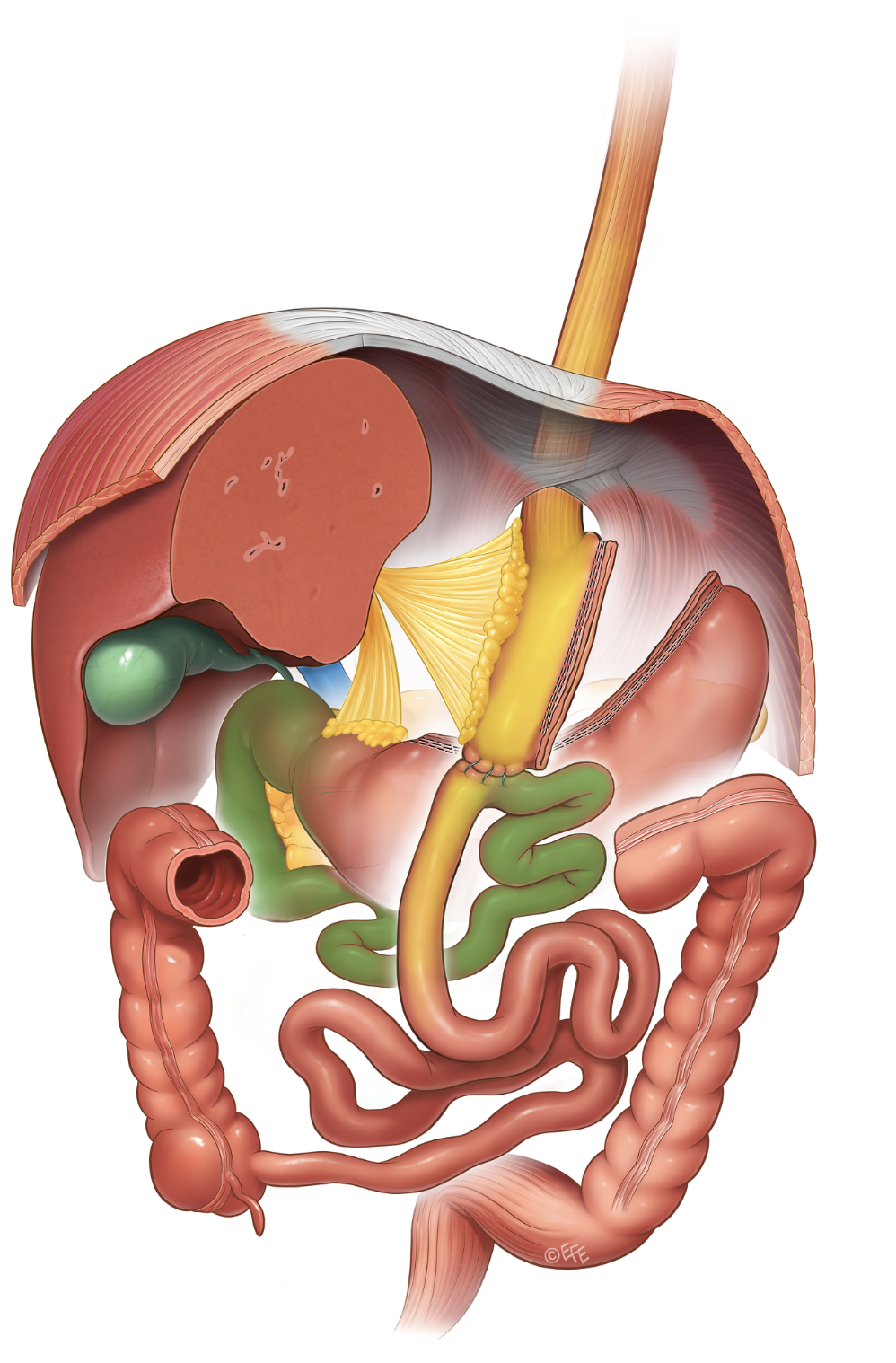 Medizinische Illustration: Omega-Loop Bypass (OAGB)