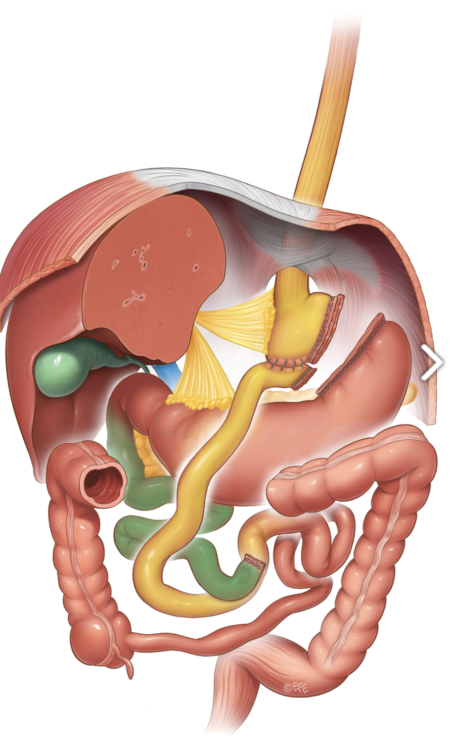 Medizinische Illustration: SADI-S