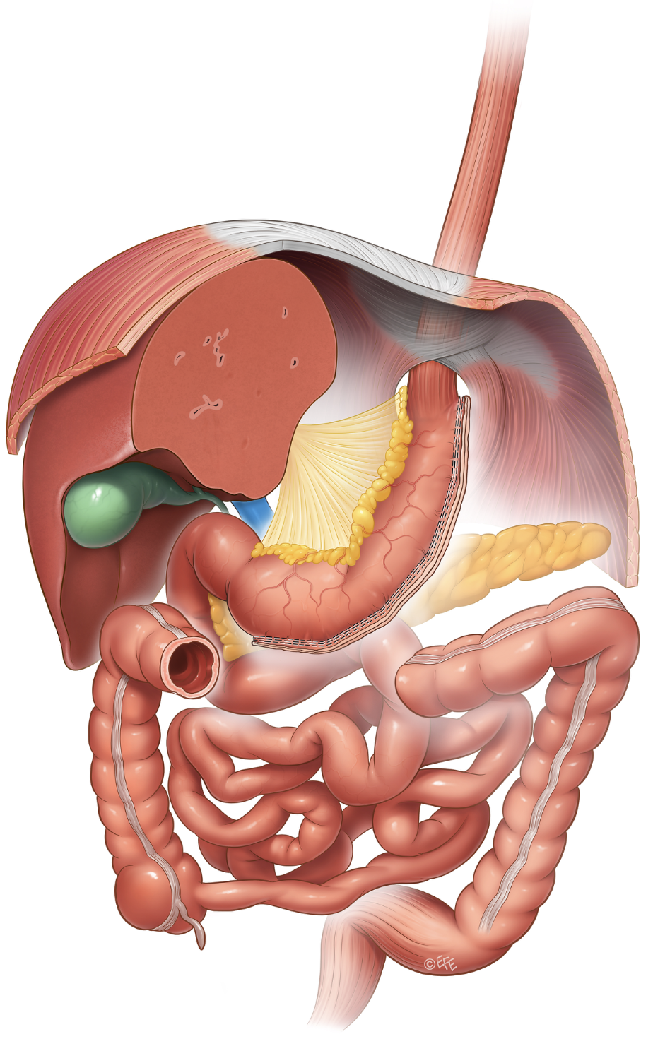 Medizinische Illustration: Schlauchmagen (Sleeve Gastrectomy)