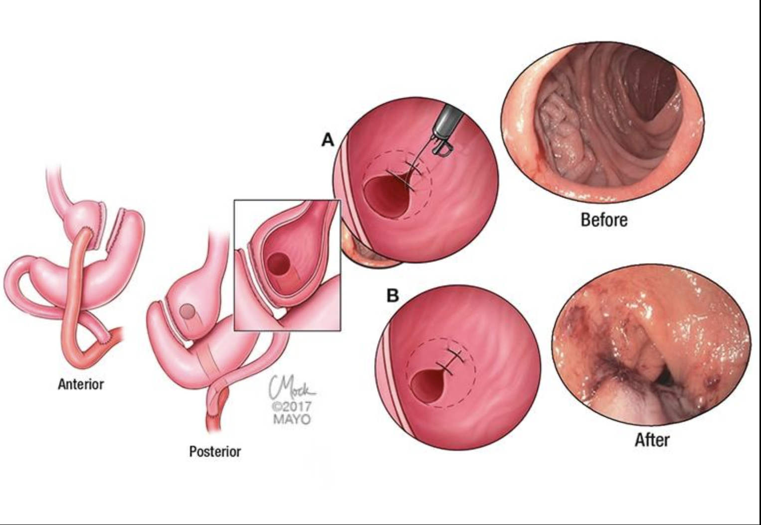 Medizinische Illustration: Transoral Outlet Reduction