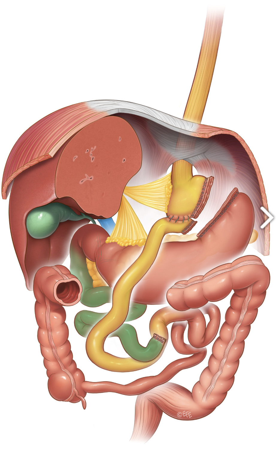 Medizinische Illustration: Roux-en-Y Magenbypass