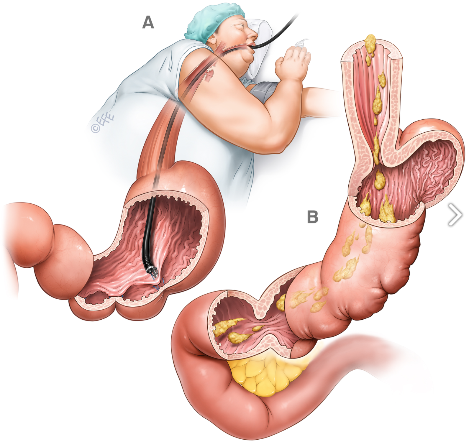 Medizinische Illustration: Endoskopische Sleeve Gastroplastik