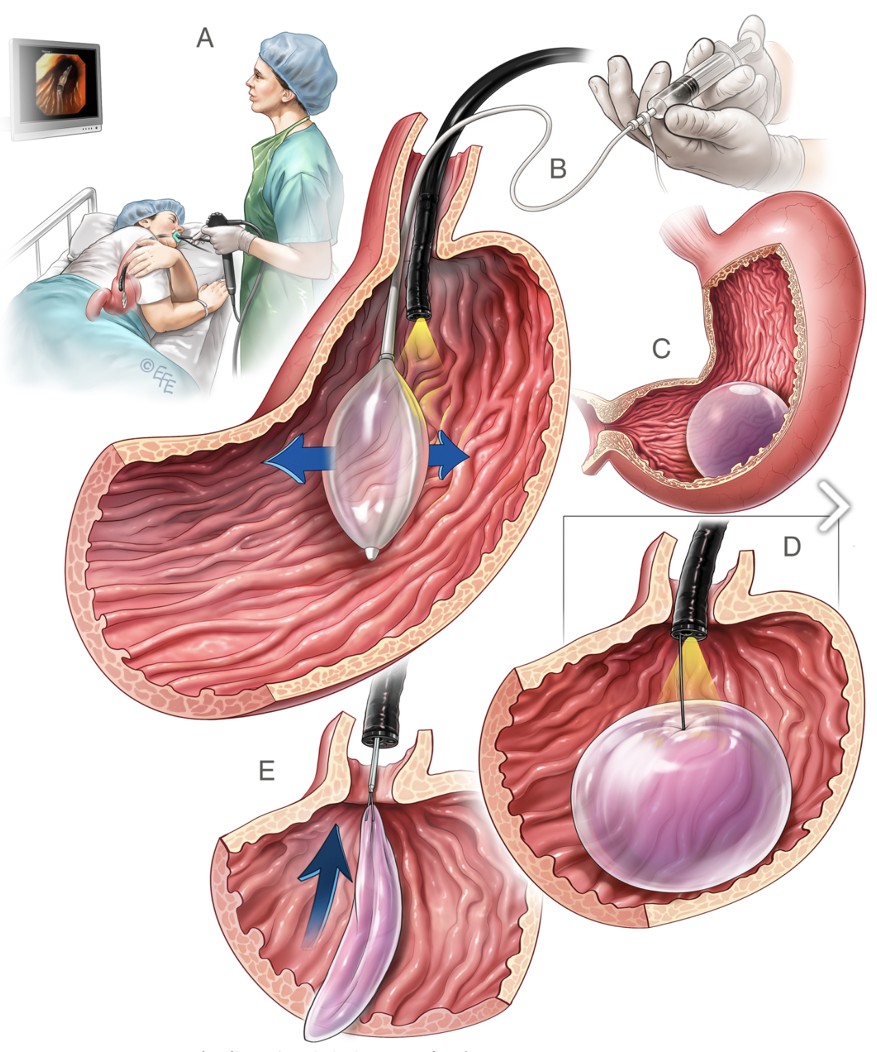 Medizinische Illustration: Magenballon